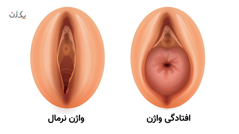 علائم افتادگی رحم